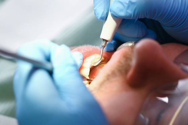 Best Emergency Wisdom Teeth Removal in Patton Village, TX